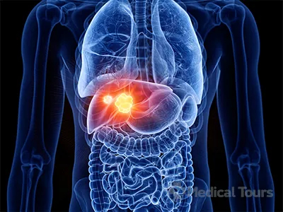 Liver Cancer Treatment In UK
